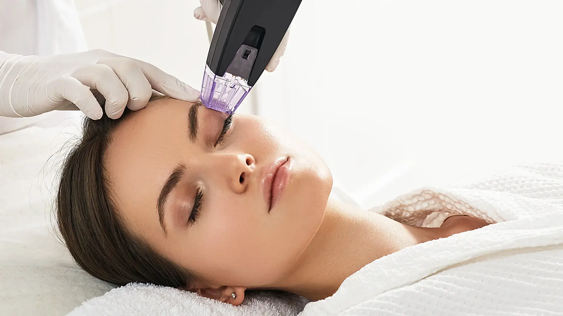 IPL treatment in Miami