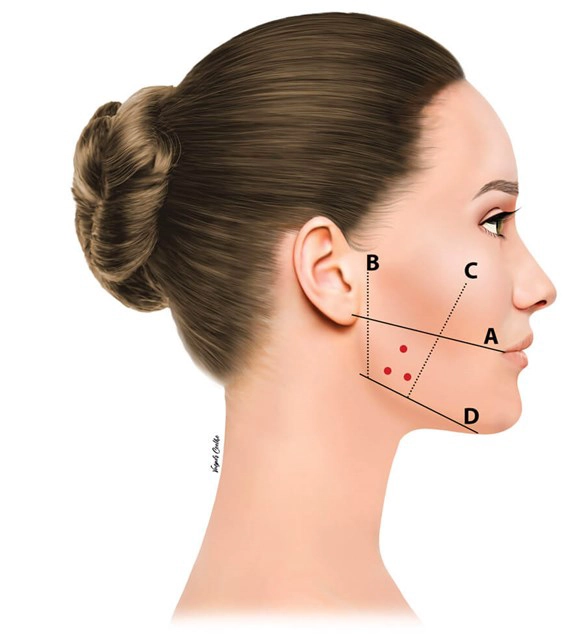 Masseter Botox procedure being performed
