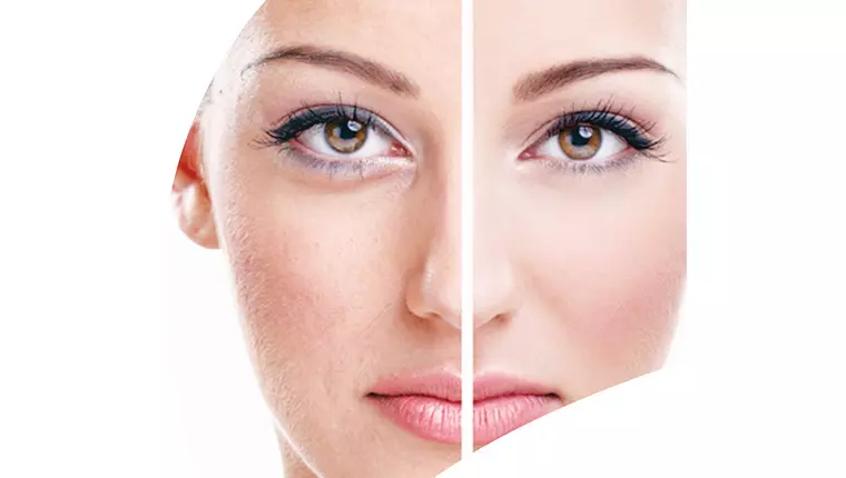 Microneedling treatment procedure at Femme Aesthetics Miami