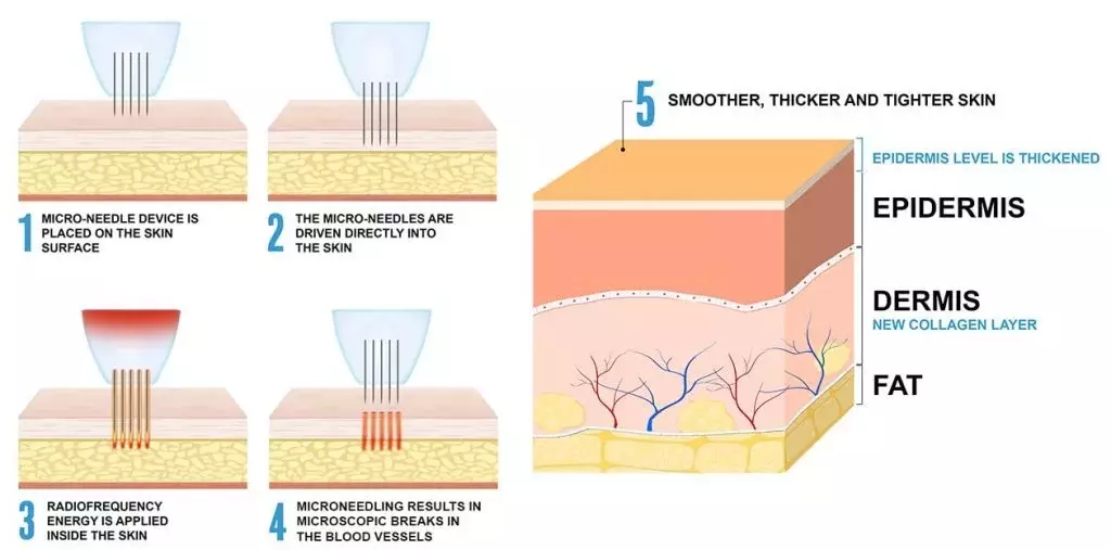 The science behind microneedling treatment and collagen induction therapy
