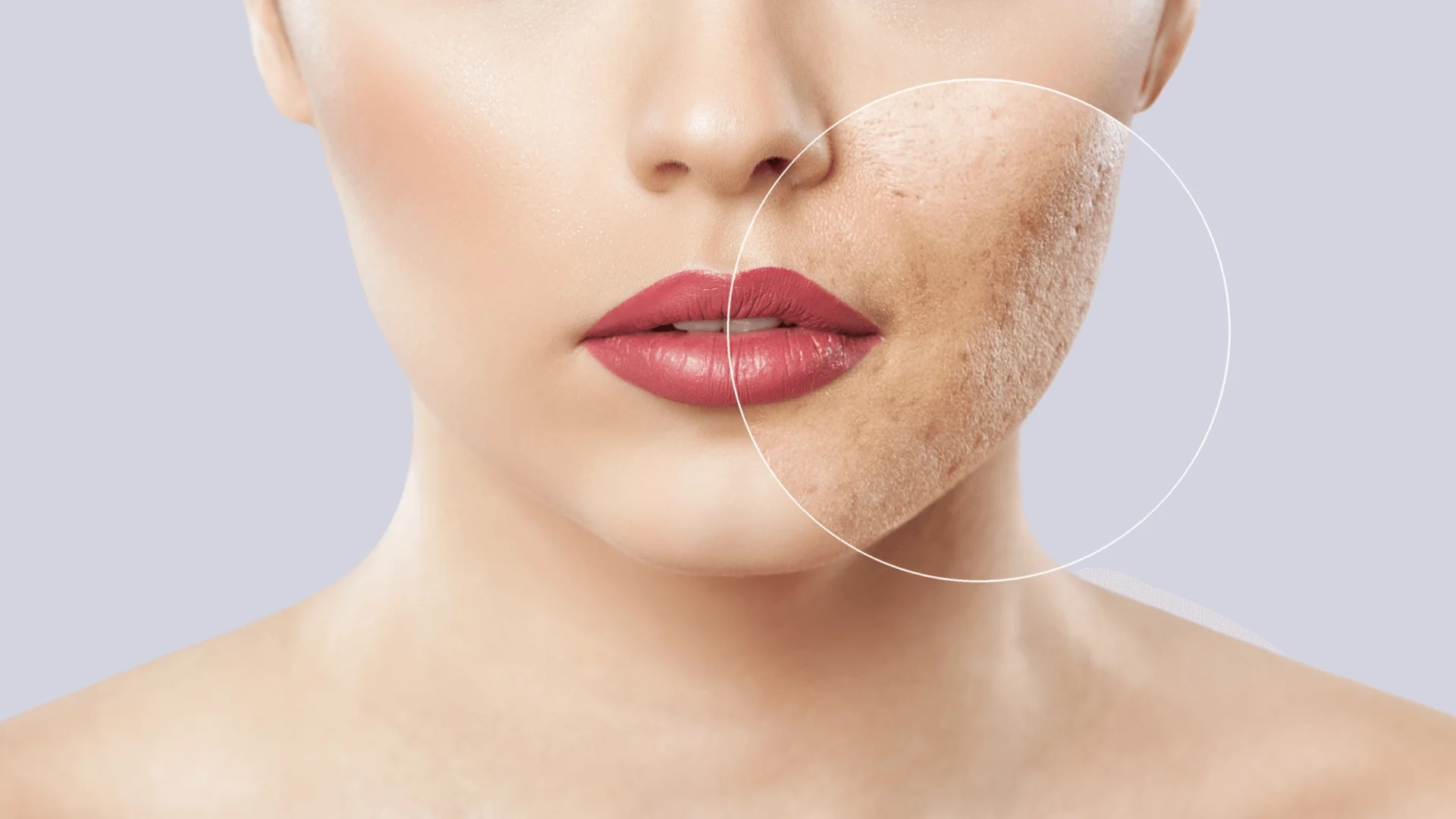 Morpheus8 treatment results for acne scars and blemishes