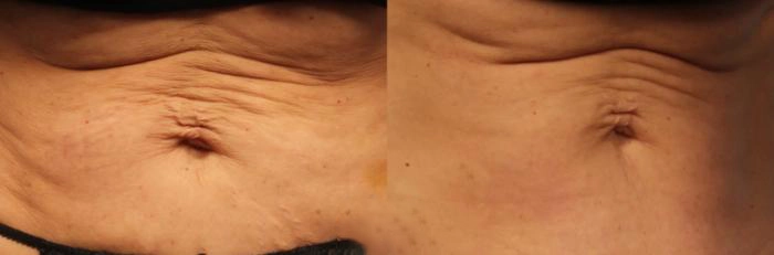 Morpheus8 before and after results on stomach - front view