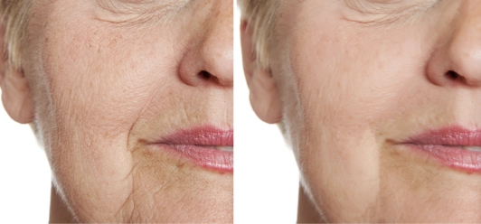 Morpheus8 before and after results