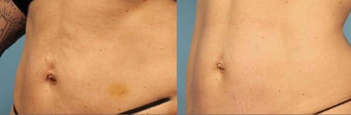 Morpheus8 Body Contouring