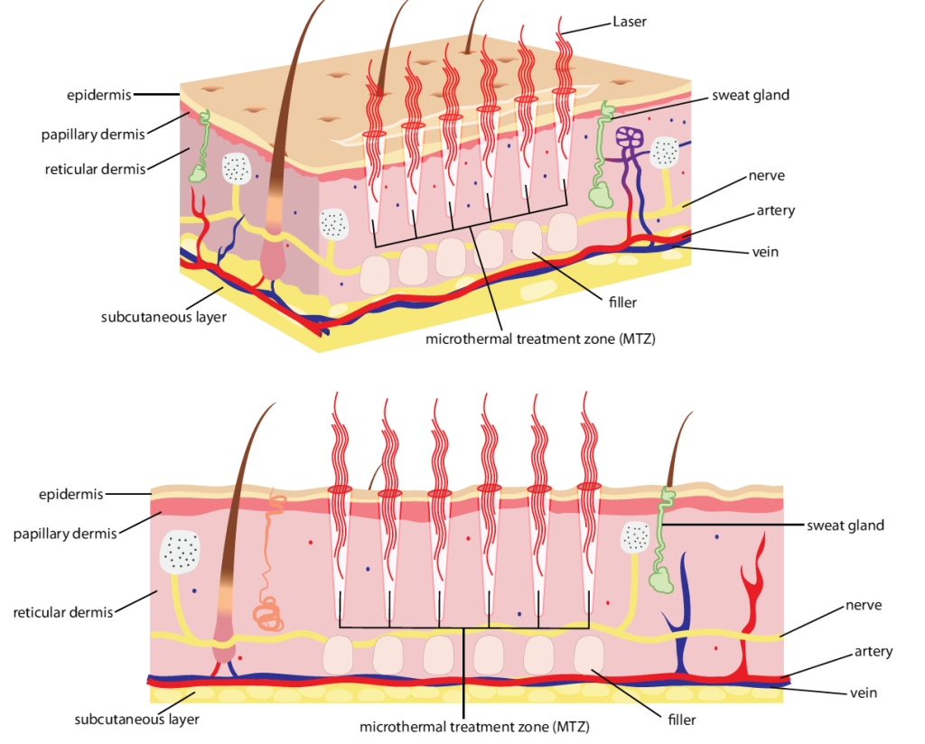 Morpheus8 skin penetration diagram showing how RF energy reaches deeper skin layers