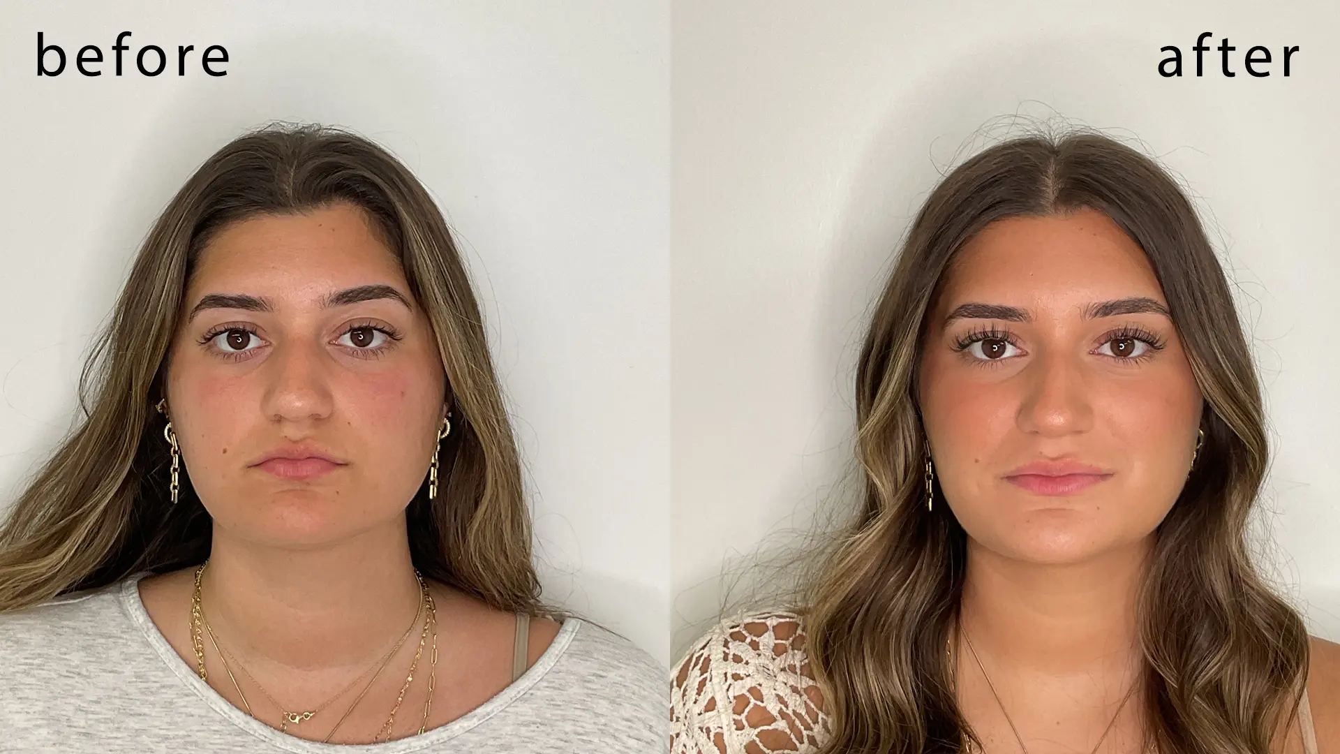 Natural looking lip fillers before and after results at Femme Aesthetics Miami