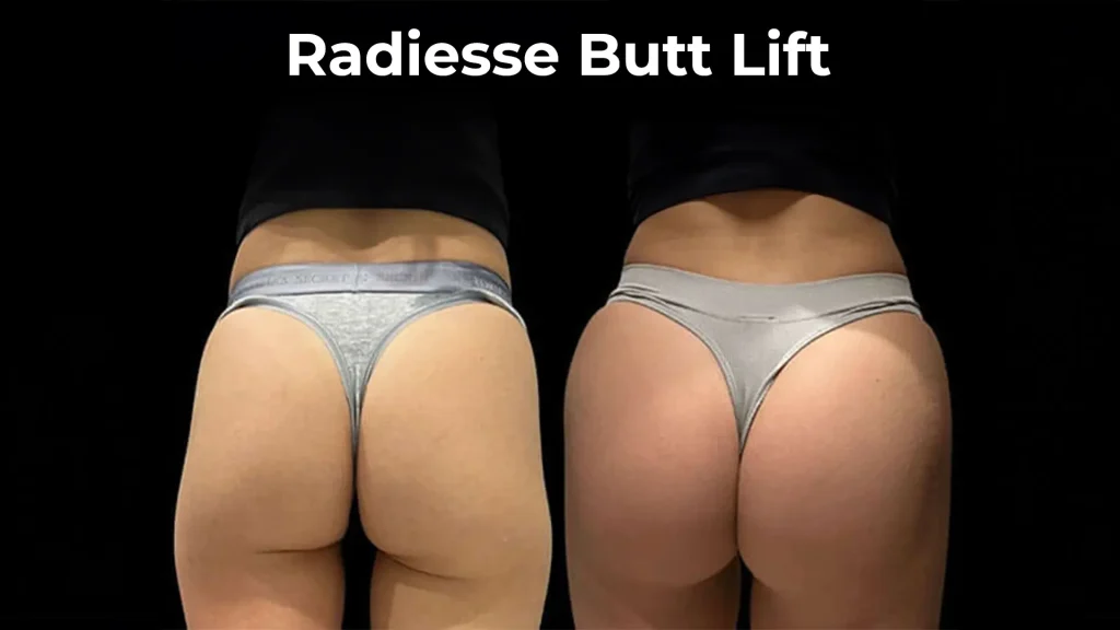 Radiesse non-surgical butt lift before and after comparison