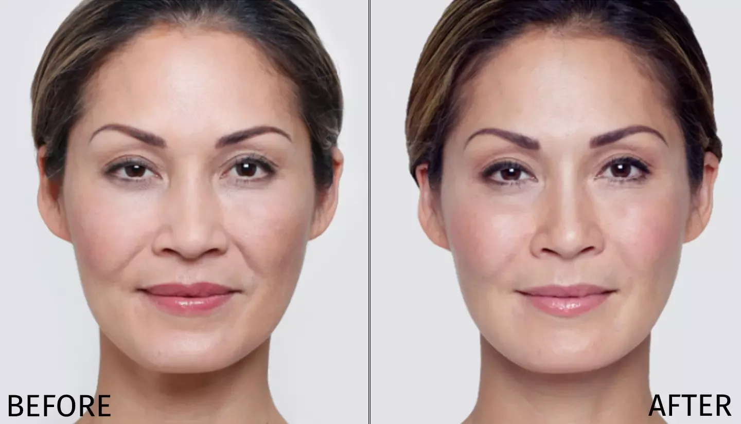 Restylane cheeks before and after - showing restored midface volume and youthful contours