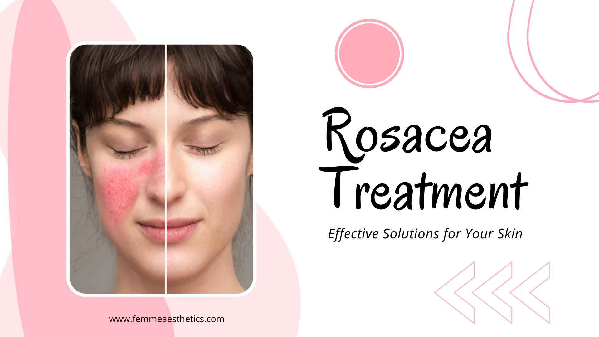 Rosacea Treatment Miami - Effective Solutions for Your Skin at Femme Aesthetics