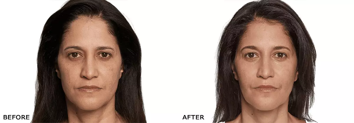 Sculptra Before and After Results - Long-Term Improvement