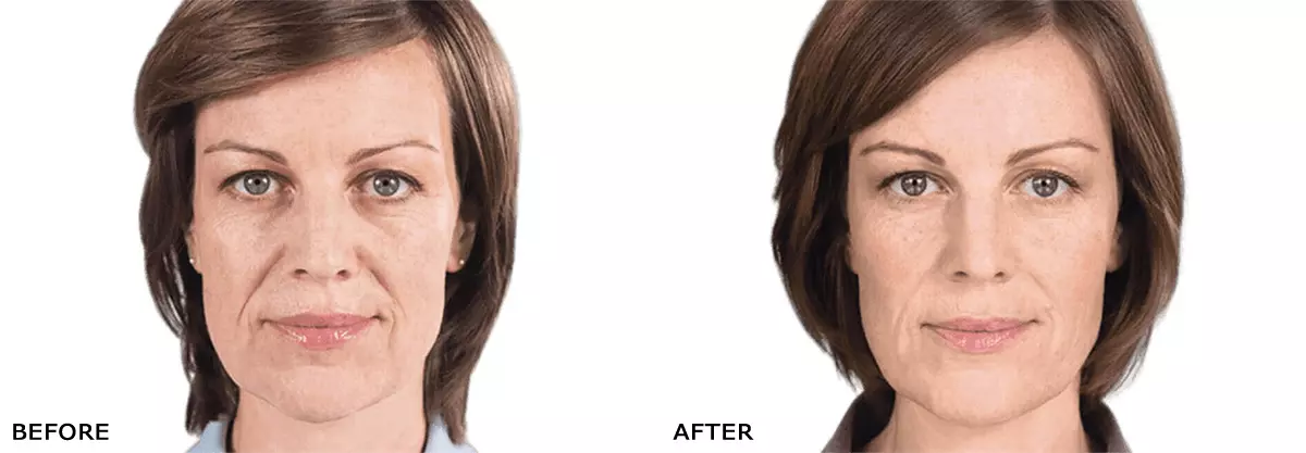 Sculptra Before and After results