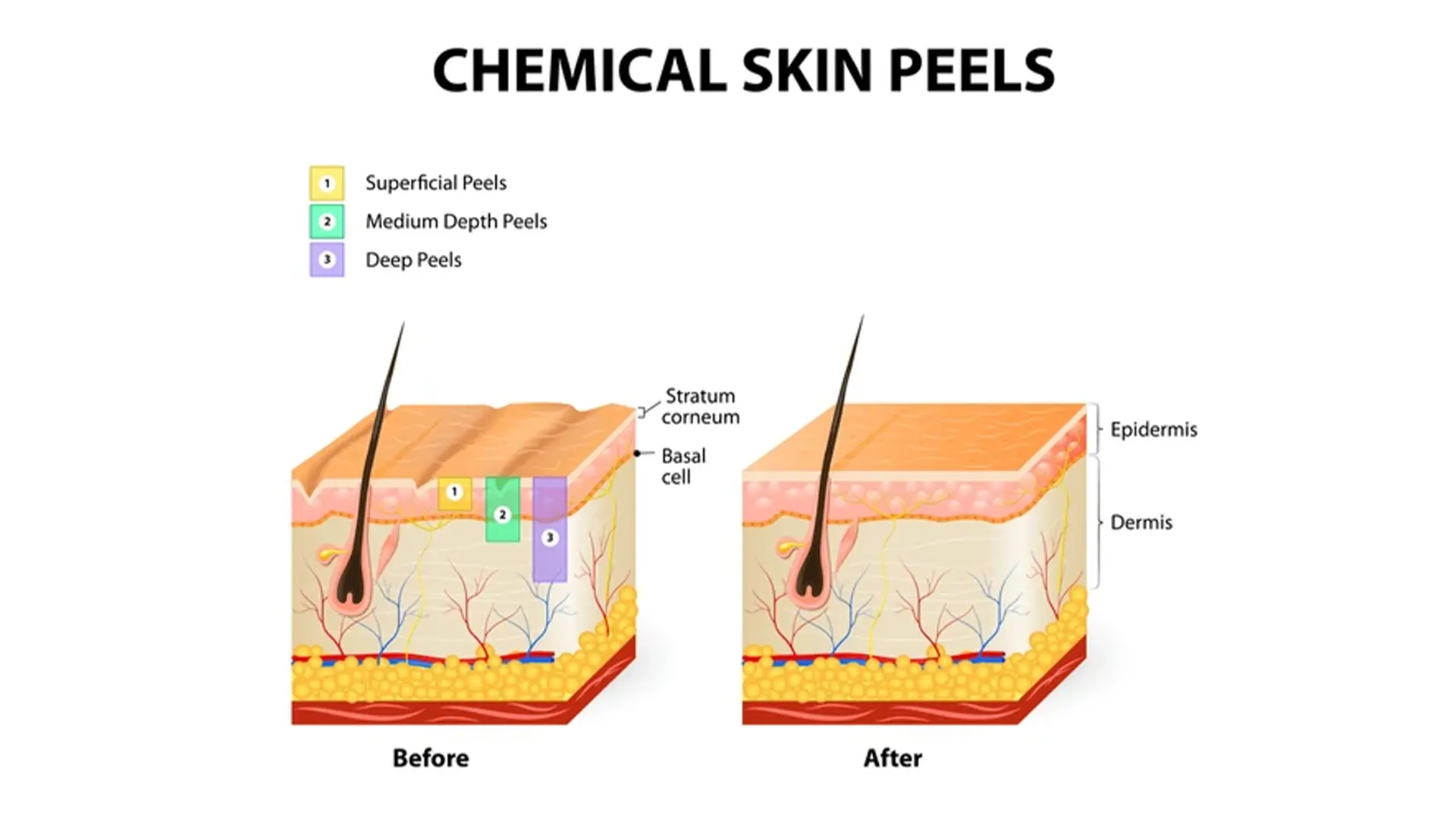 skincare treatments chemical peels
