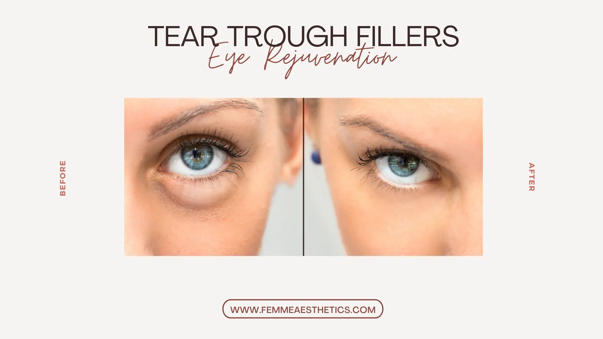 Tear Trough Filler