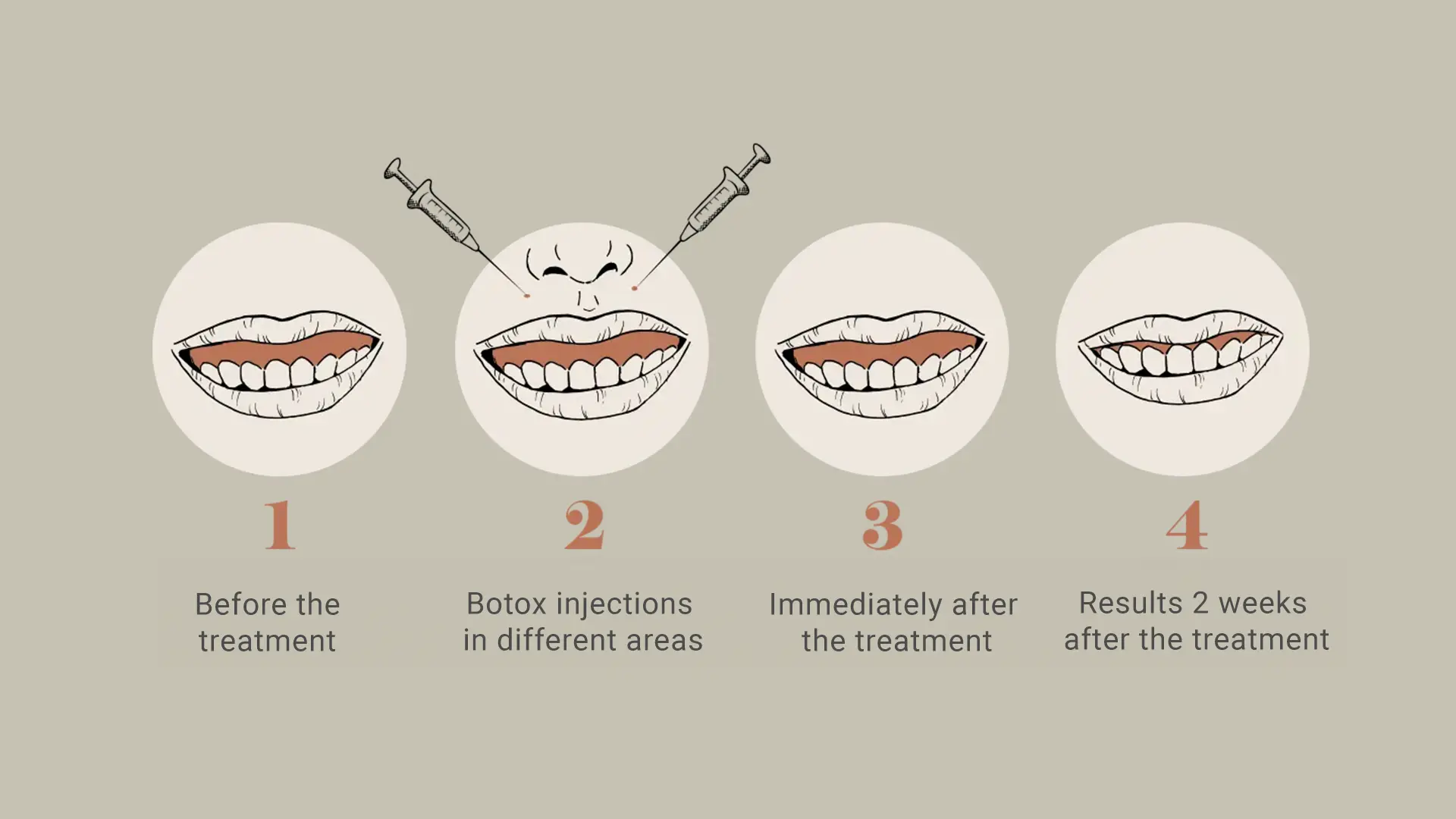 Understanding the Gummy Smile and Treatment Procedure