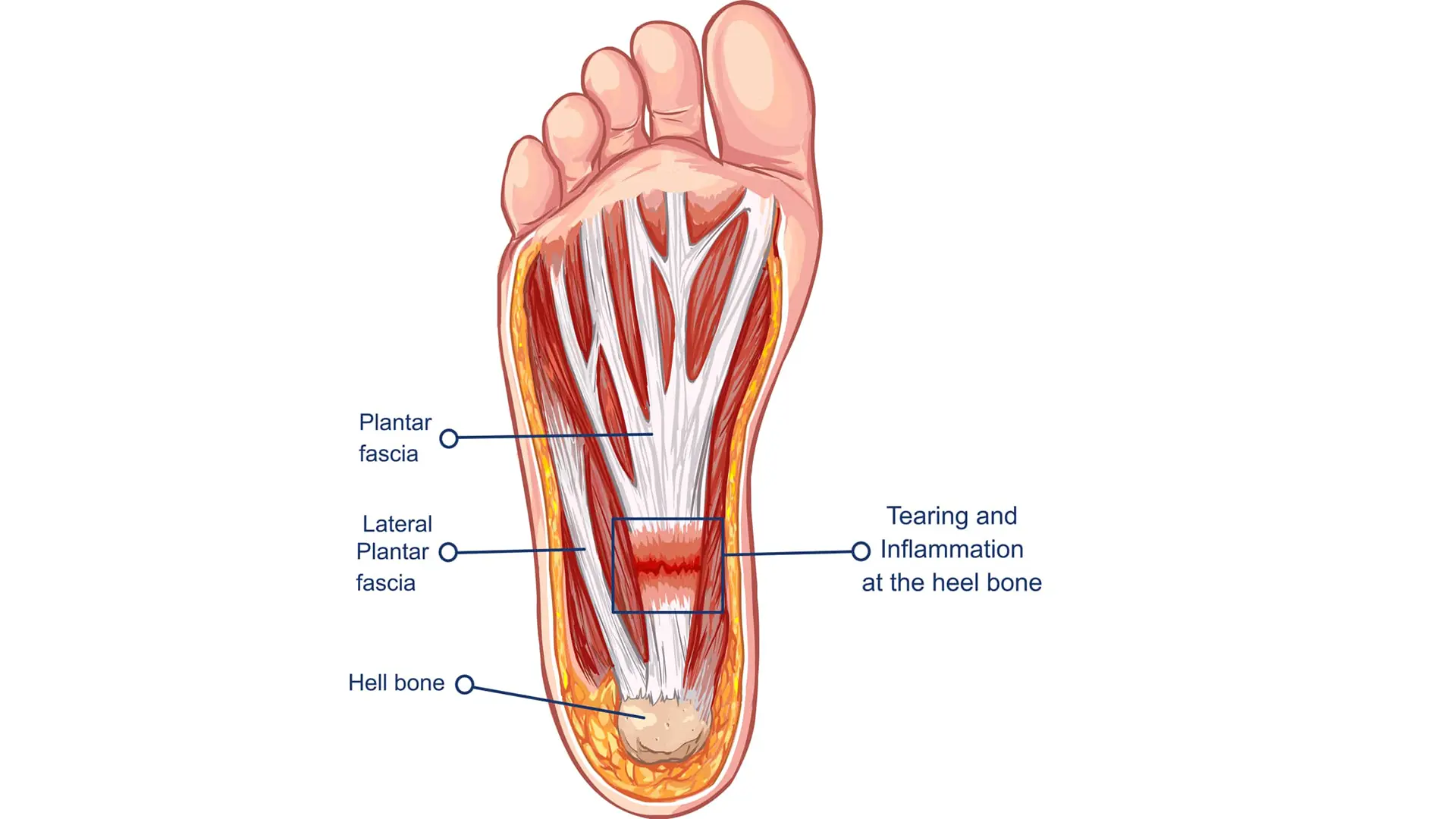 Understanding plantar fasciitis &ndash; anatomy and symptoms of heel pain