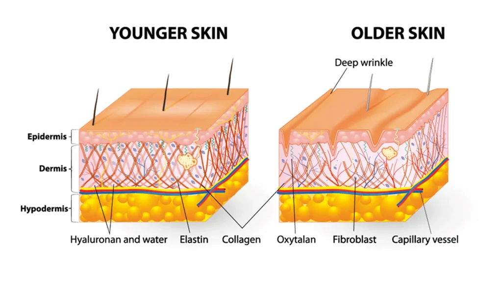 Younger skin compared to older skin showing how Radiesse butt lift stimulates collagen
